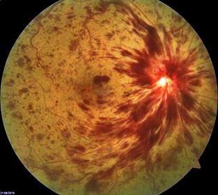 ÙØªÙØ¬Ø© Ø¨Ø­Ø« Ø§ÙØµÙØ± Ø¹Ù âªcrvo eyeâ¬â