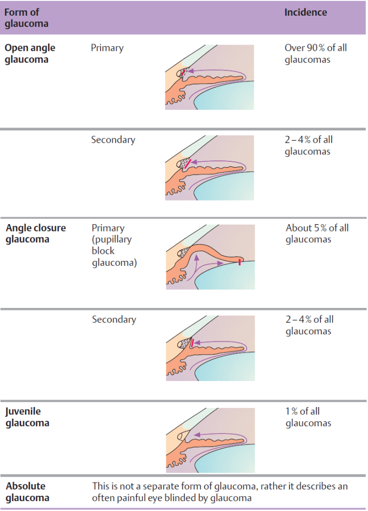 table glaucoma 2